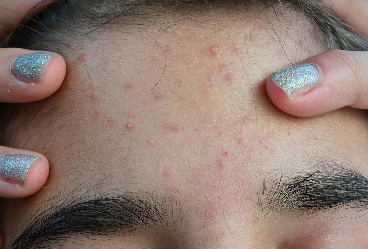 Forehead Particles Home Remedies to Reduce Bumps on Forehead - Navtarang